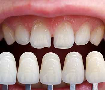 Burr Ridge dental practice offers porcelain veneers