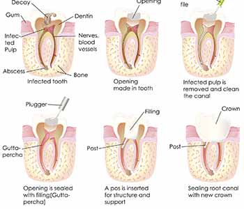 Burr Ridge dentist describes root canal