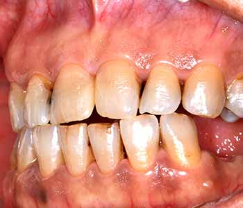 gum therapy treats the causes of gum disease gently in our Burr Ridge