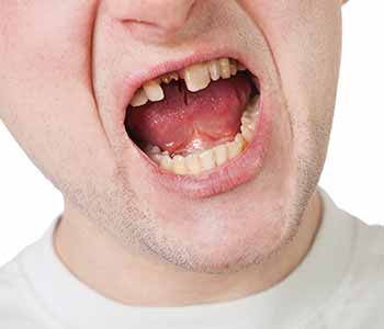 Damaged teeth deserve meticulous repair