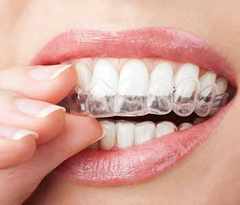Invisalign work and where can I get treatment in Burr Ridge, IL