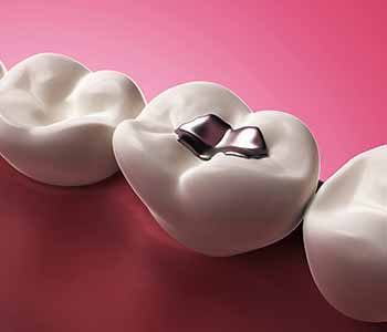 There is a safe way to remove silver or amalgam fillings that contain mercury and Dr. Janet Stopka has invested in the techniques and tools