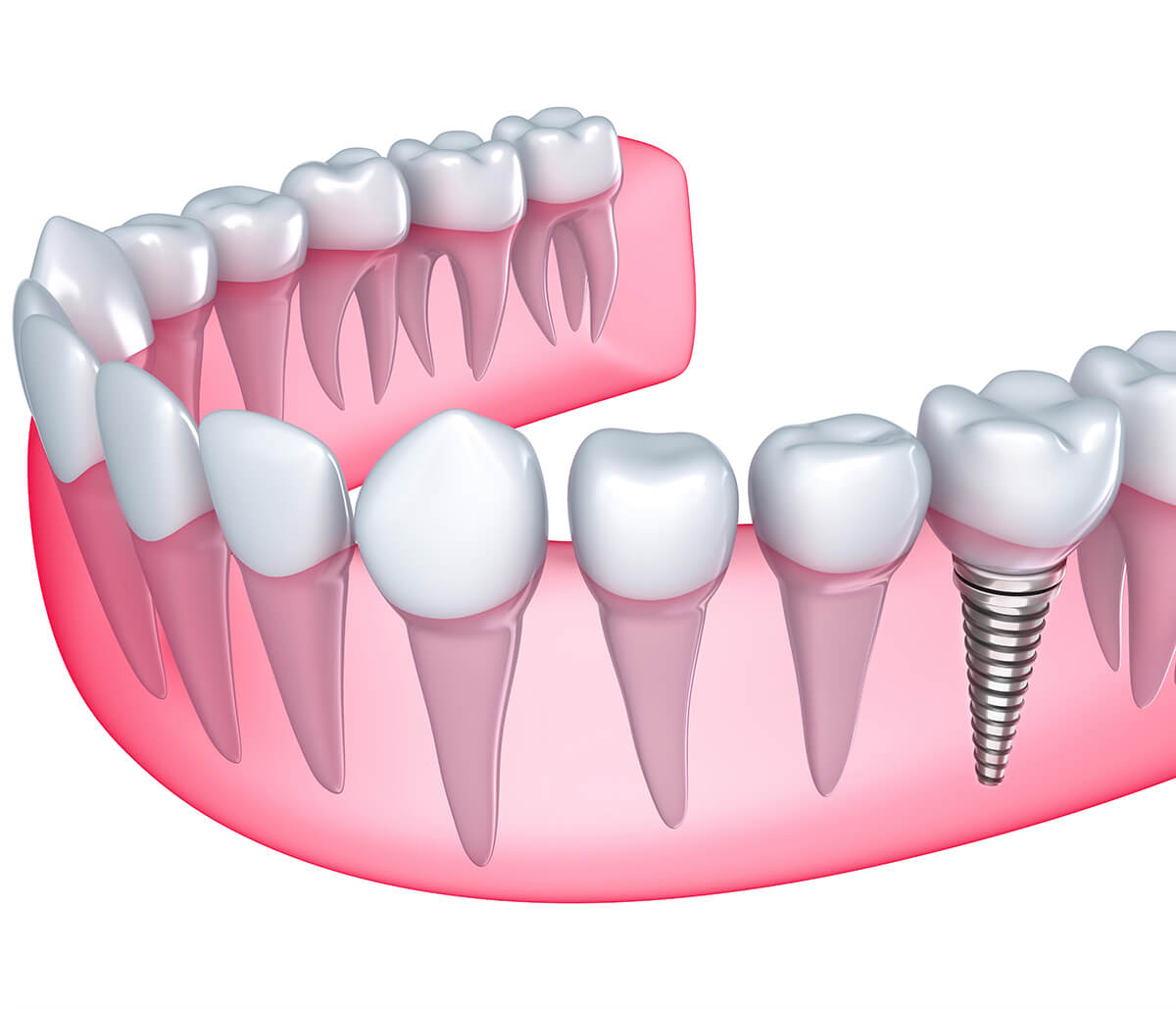 Rejuvenate Smile with Teeth Implants Procedure in Burr Ridge IL Area