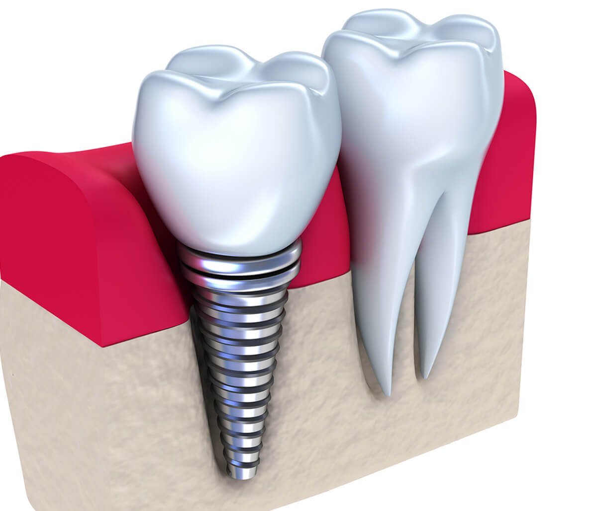 Teeth Implants Dentist in Burr Ridge IL Area